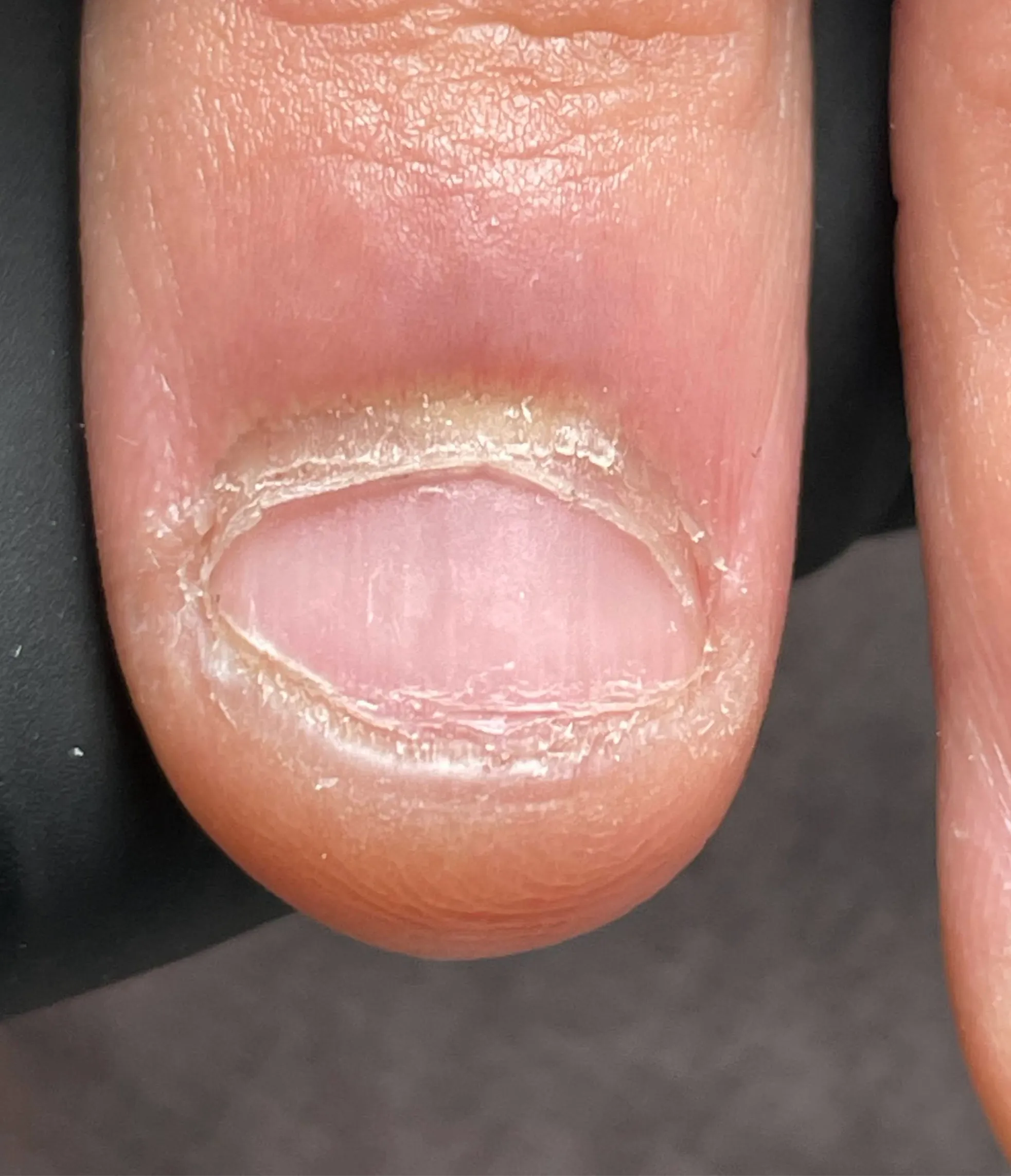Onychophagia Treatment